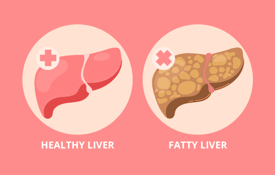 What is a Fatty liver ? What are the Symptoms of Fatty liver?