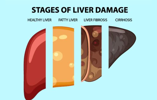Liver Cirrhosis | What is it and how to prevent a cirrhotic liver